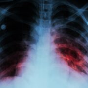 Llaman a prevenir la tuberculosis