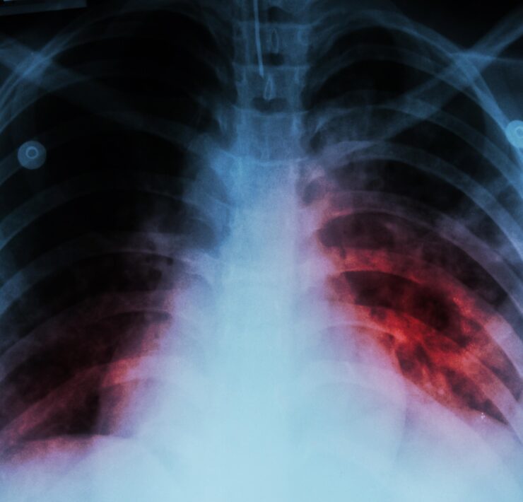 Llaman a prevenir la tuberculosis