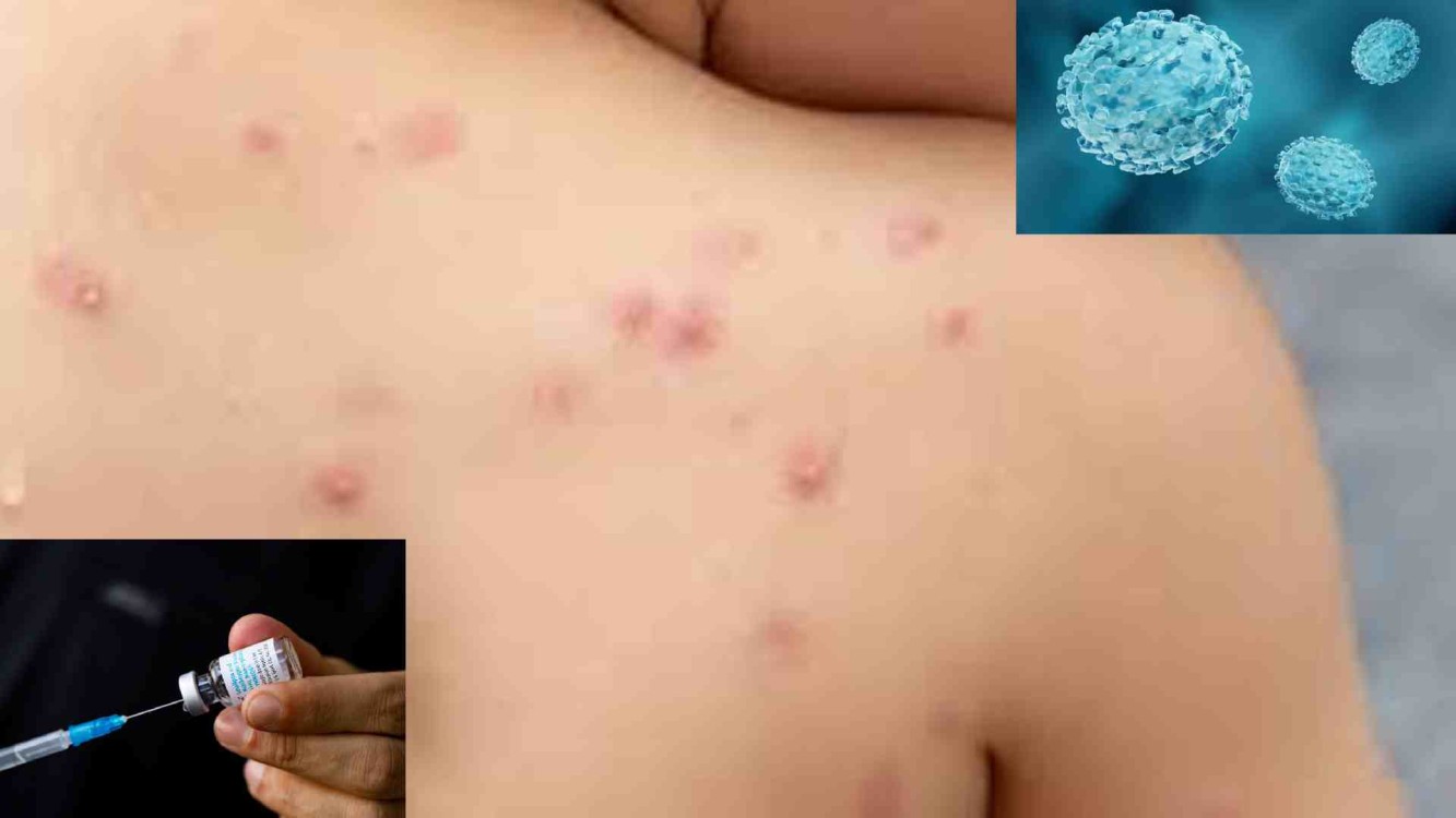 Cuatro estados de la república mexicana, han reportado casos de la Viruela del Mono también conocida como Mpox.